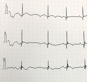 異常心電図